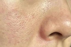 哪些行为造成了毛孔粗大?肤质不同,有不同的护理技巧